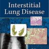 Interstitial Lung Disease