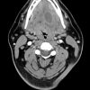 Imaging Mastery Series: Pathology of the Oral Cavity and Oropharynx 2020