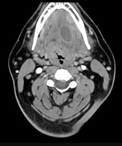 Imaging Mastery Series: Pathology of the Oral Cavity and Oropharynx 2020