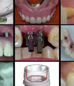 Gidedental A-Z in Restorative Implant Dentistry (CME VIDEOS)