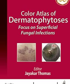 Color Atlas of Dermatophytoses: Focus on Superficial Fungal Infections (PDF)