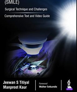 Small Incision Lenticule Extraction (SMILE): Surgical Technique and Challenges (Comprehensive Text and Video Guide) (PDF)