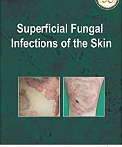 Superficial Fungal Infections of the Skin (PDF)