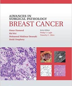 Advances in Surgical Pathology: Breast Cancer (EPUB)