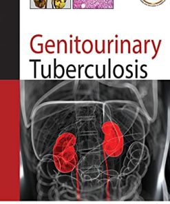 Genitourinary Tuberculosis (PDF)