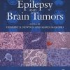 Epilepsy and Brain Tumors