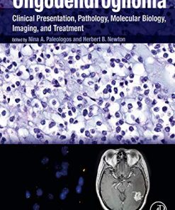 Oligodendroglioma: Clinical Presentation, Pathology, Molecular Biology, Imaging, and Treatment (PDF)