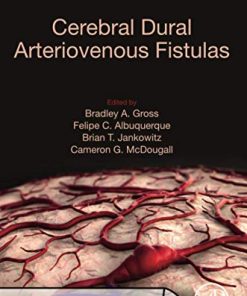 Cerebral Dural Arteriovenous Fistulas (PDF)