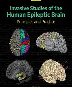 Invasive Studies of the Human Epileptic Brain: Principles and Practice