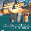 Tibial Plateau Fractures (PDF) Tibial Plateau Fractures (PDF)