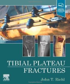 Tibial Plateau Fractures (PDF)