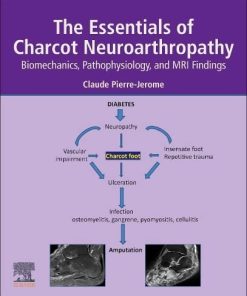 The Essentials of Charcot Neuroarthropathy: Biomechanics, Pathophysiology, and MRI Findings (PDF)