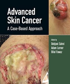 Advanced Skin Cancer: A Case-Based Approach (PDF)