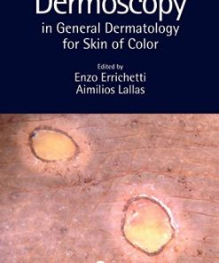 Dermoscopy in General Dermatology for Skin of Color (PDF)