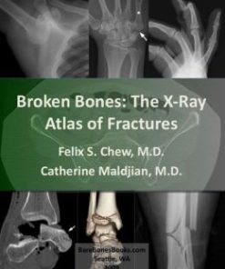 Broken Bones: The X-Ray Atlas of Fractures (EPUB)