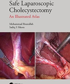 Safe Laparoscopic Cholecystectomy: An Illustrated Atlas (PDF)