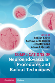 Complications of Neuroendovascular Procedures and Bailout Techniques (Retail PDF)