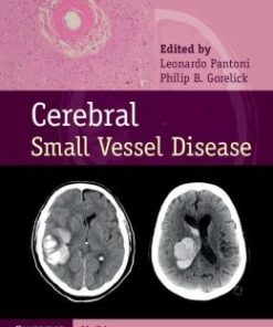 Cerebral Small Vessel Disease