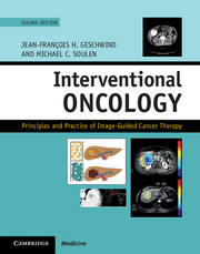 Interventional Oncology Principles and Practice of Image-Guided Cancer Therapy, 2nd Edition (Retail PDF)