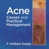 Acne: Causes and Practical Management