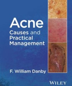 Acne: Causes and Practical Management