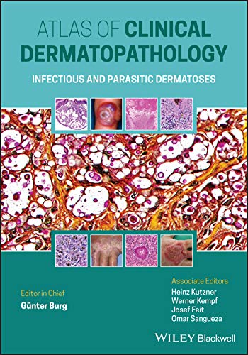 Atlas Clinical of Dermatopathology: Infectious and Parasitic Dermatoses (PDF) Atlas Clinical of Dermatopathology: Infectious and Parasitic Dermatoses (PDF)