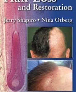 Hair Loss and Restoration, 2nd Edition