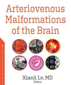 Arteriovenous Malformations of the Brain (PDF)