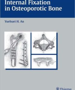 Internal Fixation in Osteoporotic Bone