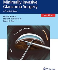 Minimally Invasive Glaucoma Surgery: A Practical Guide (PDF)