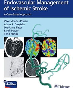 Endovascular Management of Ischemic Stroke: A Case-Based Approach (PDF)