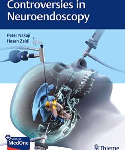 Controversies in Neuroendoscopy (PDF)