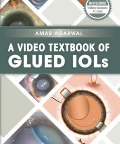 A Video Textbook of Glued IOLs