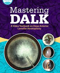 Mastering DALK: A Video Textbook on Deep Anterior Lamellar Keratoplasty (PDF)