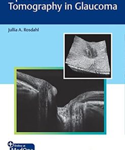 Optical Coherence Tomography in Glaucoma (PDF)