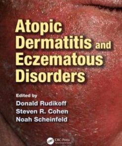 Atopic Dermatitis and Eczematous Disorders