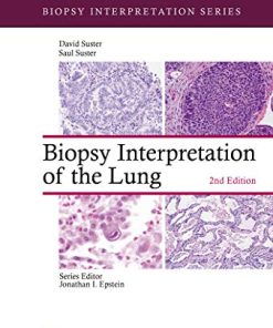 Biopsy Interpretation of the Lung, 2ed (Biopsy Interpretation Series) (EPUB)