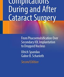 Complications During and After Cataract Surgery: From Phacoemulsification Over Secondary IOL Implantation to Dropped Nucleus, 2nd Edition (PDF)