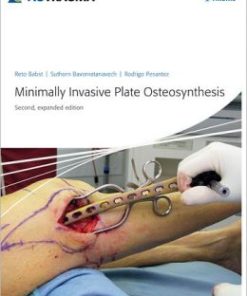 Minimally Invasive Plate Osteosynthesis (MIPO) (PDF)