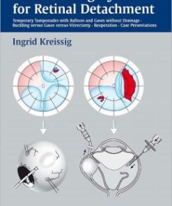 A Practical Guide to Minimal Surgery for Retinal Detachment, Volume 2