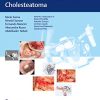 Microsurgical Management of Middle Ear and Petrous Bone Cholesteatoma (PDF)