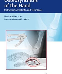 Osteosynthesis of the Hand: Instruments, Implants, and Techniques (PDF)