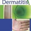 Atopic Dermatitis (PDF)