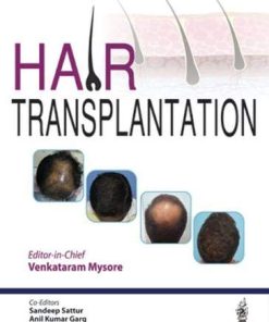 Hair Transplantation (PDF)