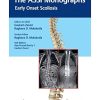 The ASSI Monographs: Early Onset Scoliosis (PDF)