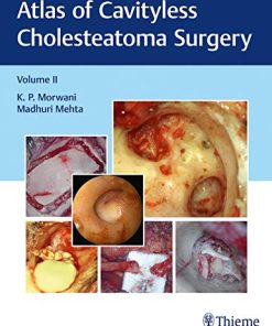 Atlas of Cavityless Cholesteatoma Surgery (Volume 2) (PDF)