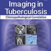 Imaging in Tuberculosis: Clinicopathological Correlation (PDF)