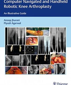 Computer Navigated and Handheld Robotic Knee Arthroplasty: An Illustrative Guide (PDF)