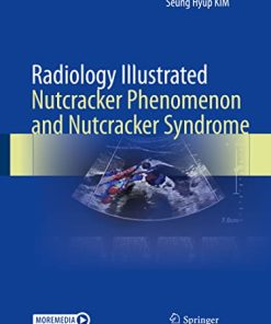 Radiology Illustrated: Nutcracker Phenomenon and Nutcracker Syndrome (PDF)