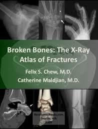 Broken Bones: The X-Ray Atlas of Fractures